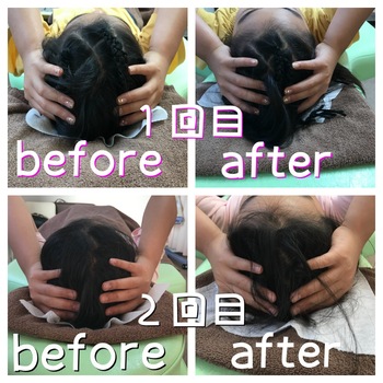 施術前後で頭の大きさが変わります